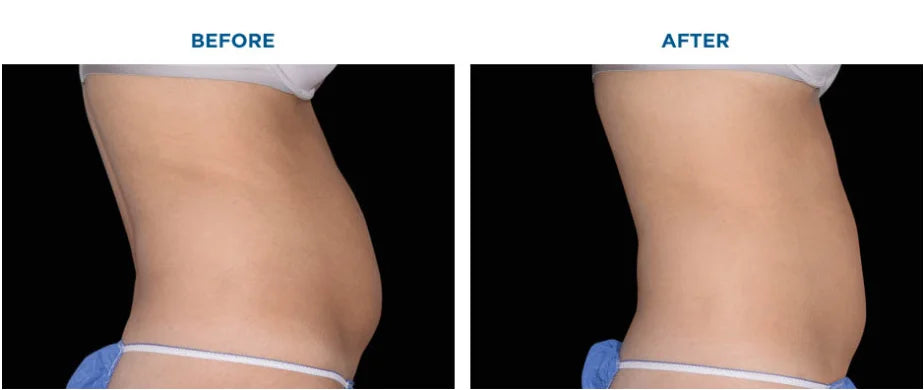MYOslim NEO Body Fat Burning Carving Machine 15 Tesla EMS Electromagnetic Weight Loss Muscle Training Slimming Machine