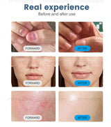 MYOSLIM 5-in-1 980nm Diode Laser Beauty Device