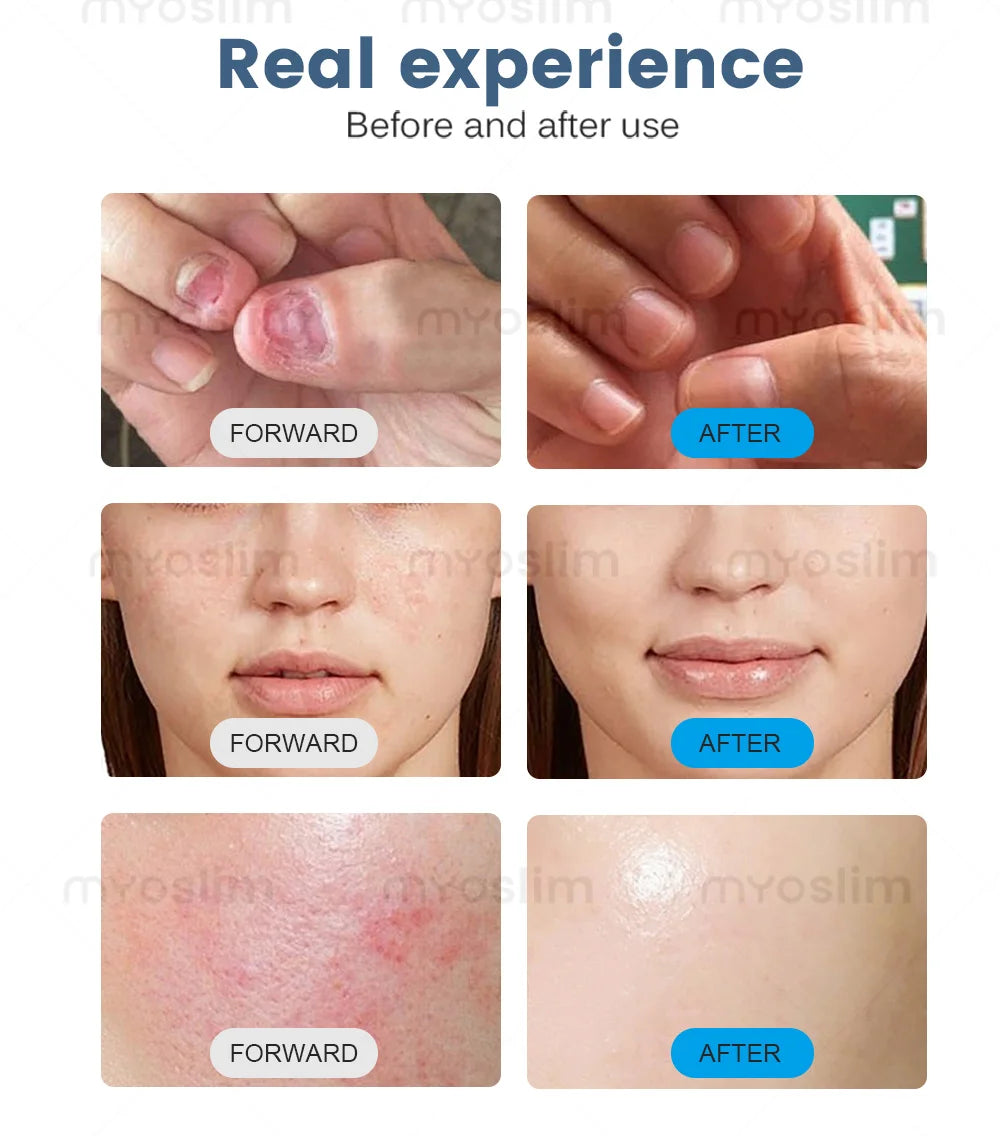 MYOSLIM 5-in-1 980nm Diode Laser Beauty Device